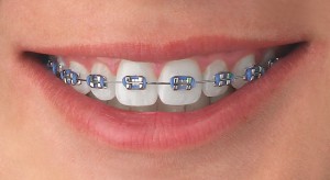Kieferorthopädie - Feste Zahnspangen, Brackets